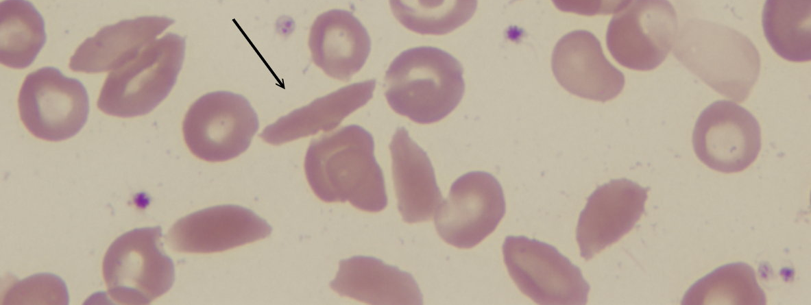 Srpkovité erytrocyty Klinický význam - srpkovitá anémie - Hemoglobinopatie (hemoglobin SS, SC, SD, S-ß talasémie) Zdroj: