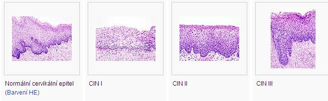 Kancerogeneze vzniku karcinomu předchází změny buněk děložního hrdla, tzv.