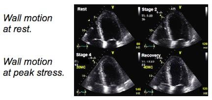 stress cardiac imaging