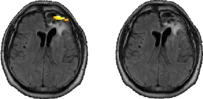 BRAIN RHYTMS předběžné výsledky ukazují, že zřejmě existují dvojice komponent z obou modalit jejichž časové průběhy těsně korelují EPI