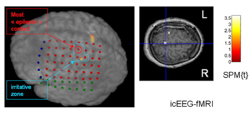 INTRAKRANIÁLNÍ EEG a fmri problém se zahříváním elektrod v důsledku indukce el.