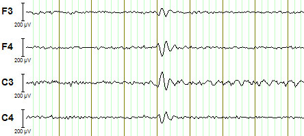 EEG-fMRI EEG výborné časové rozlišení (jednotky ms) 10-20 systém, 30 elektrod EKG, EOG 5kHz -> 250 Hz EEG-fMRI fmri výborné