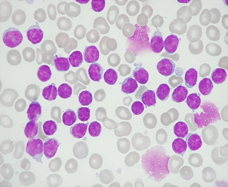 Diagnosa a rozhodnutí o léčbě 6/2004 : B-CLL, Rai II, Binet A, asymptomatický, nedobré prognostické