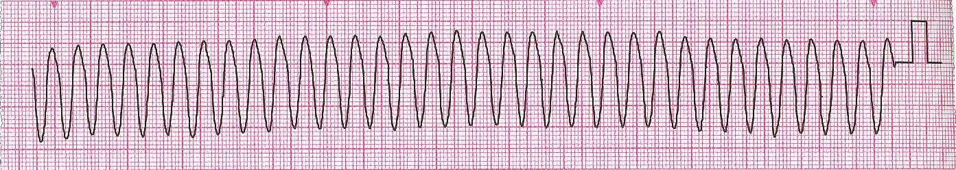 S t r á n k a 10 Vždy je preferováno zhodnocení klinického stavu nemocného, změny na EKG i jiné změny monitorovaných parametrů mohou být vyvolány technickým problémem.