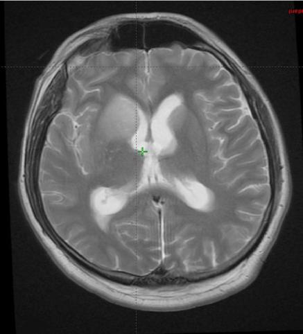 Definice míry rizika Rizikové faktory: radikalita resekce, histologie, lokalizace, diseminace v CNS či likvoru, průkaz onkogenů N-Myc či C-Myc v nádorové tkáni Vysoké riziko: reziduum větší než