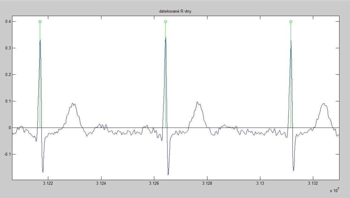 Obr. 11.: Detekce R vln Obr. 12.: Vlastní detekce R vln 4.