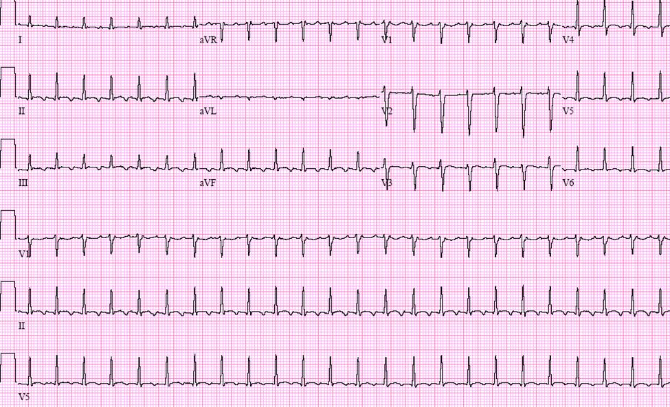 EKG Abnormální EKG identifikuje pacienty se
