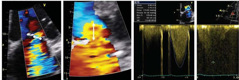 KLIDOVÉ VYŠ. VC 5 mm TR 36 mmhg ERO 0,22 cm 2 RV 40 ml ZÁTĚŽ VC 7 mm TR 77 mmhg ERO 0,38 cm 2 ( 0,16 cm 2 ) RV 69 ml Pierard L. et al.