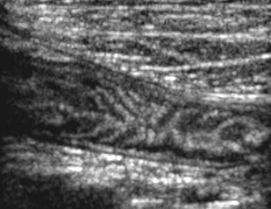 Ultrazvukové vyšetření střev: peristaltika sekrece šířka stěny ( 3 mm ) charakter