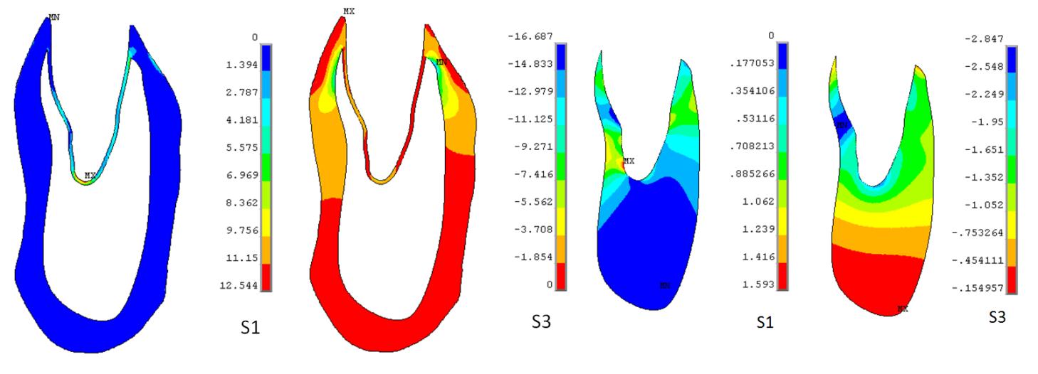 U periodontia byly pouţity tři varianty modelu materiálu: s modulem pruţnosti 1, 10 a 100 MPa. Obr.