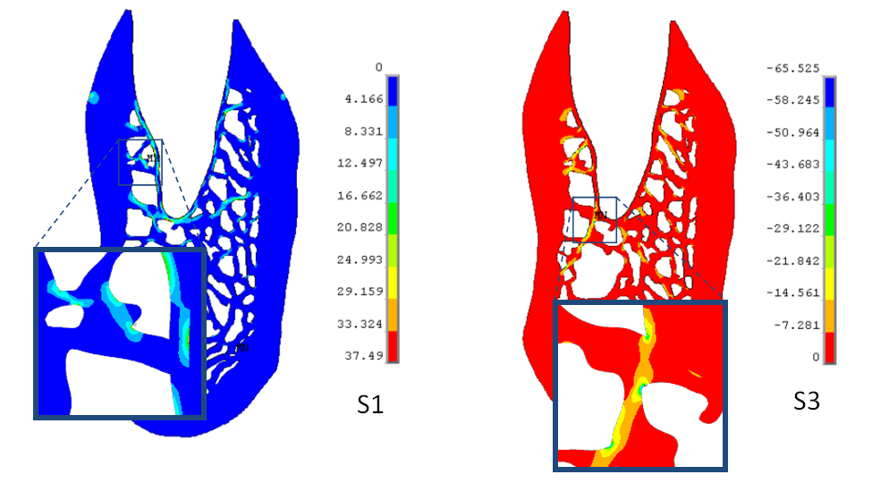 7 VÝSLEDKY A ANALÝZY 7.1 Analýzy A 2D model Cílem výpočtů na 2D modelu bylo zejm. posoudit vliv změny kvality spongiózy a modulu pruţnosti periodontia na deformaci a napjatost kosti.