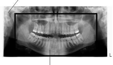 standardního programu, ale rentgenový paprsek je více kolmý na čelist.