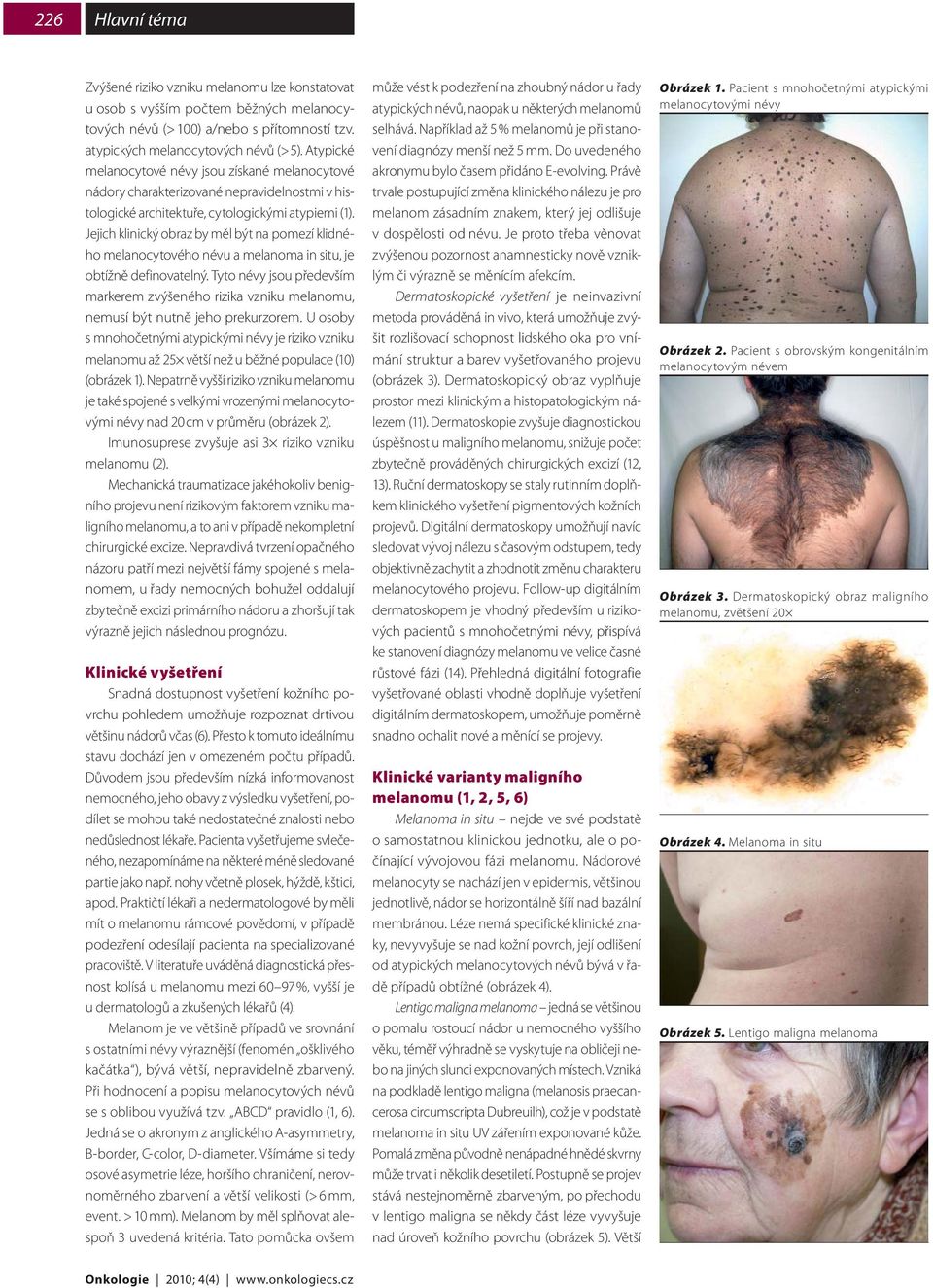 Jejich klinický obraz by měl být na pomezí klidného melanocytového névu a melanoma in situ, je obtížně definovatelný.