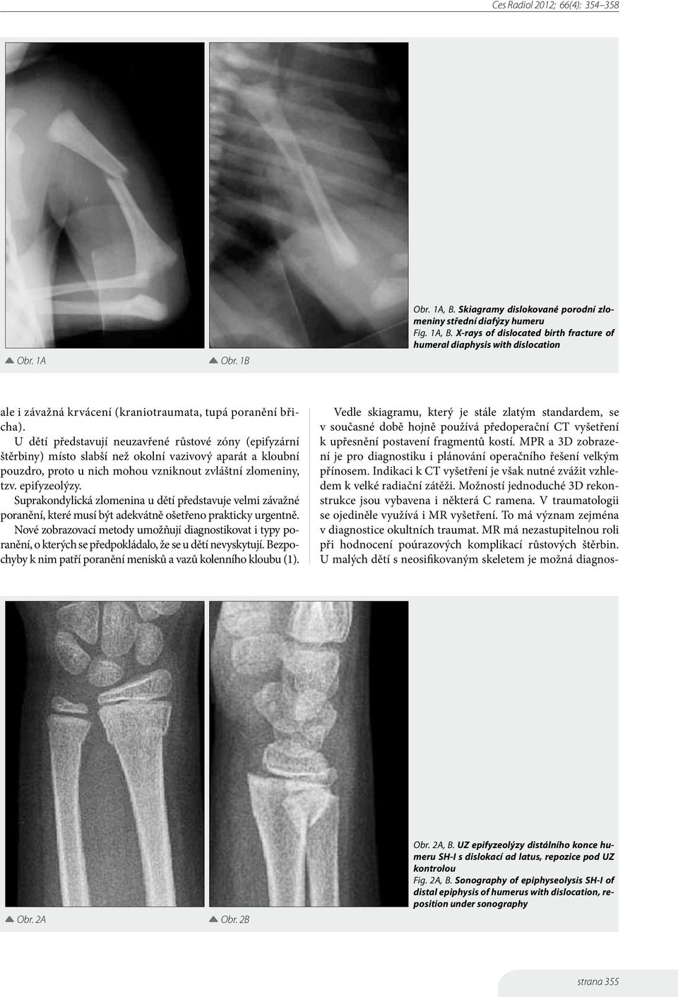 Suprakondylická zlomenina u dětí představuje velmi závažné poranění, které musí být adekvátně ošetřeno prakticky urgentně.