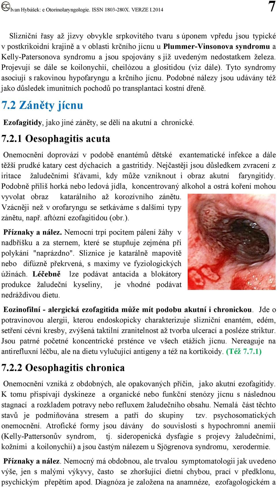 Podobné nálezy jsou udávány též jako důsledek imunitních pochodů po transplantaci kostní dřeně. 7.2 