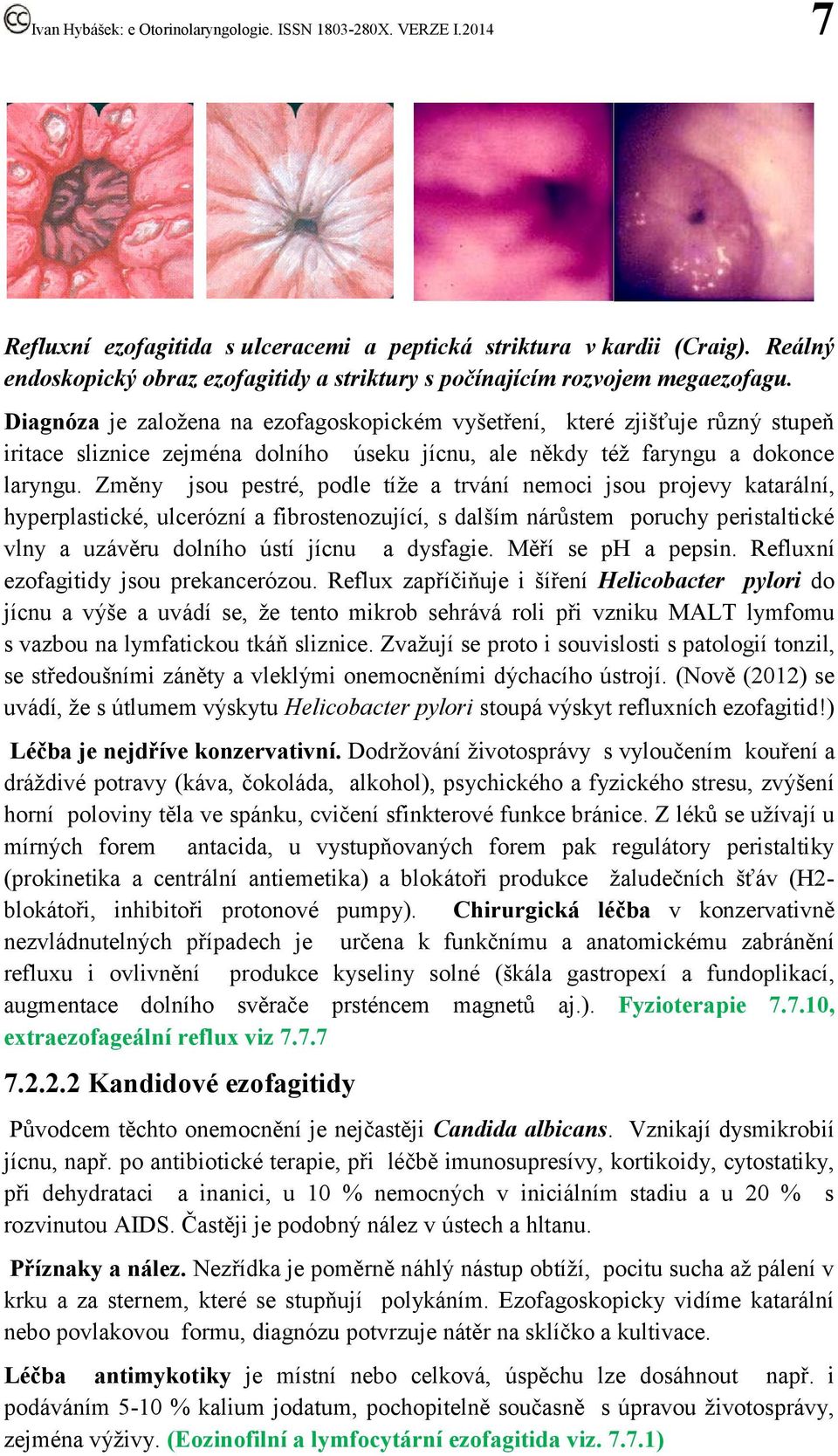 Změny jsou pestré, podle tíže a trvání nemoci jsou projevy katarální, hyperplastické, ulcerózní a fibrostenozující, s dalším nárůstem poruchy peristaltické vlny a uzávěru dolního ústí jícnu a