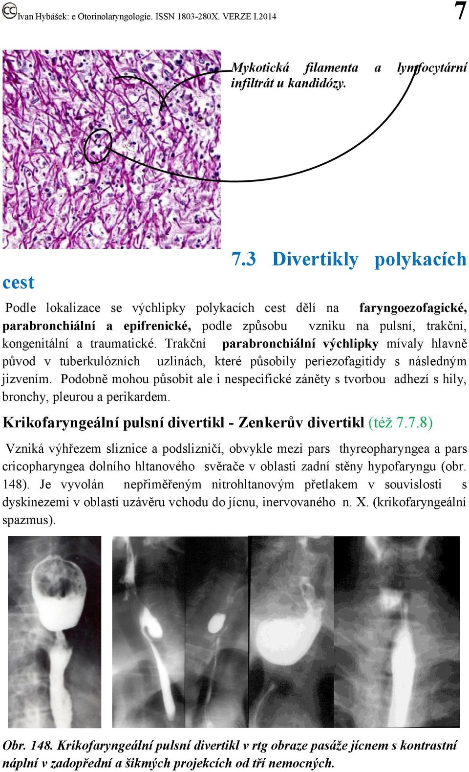 Trakční parabronchiální výchlipky mívaly hlavně původ v tuberkulózních uzlinách, které působily periezofagitidy s následným jizvením.