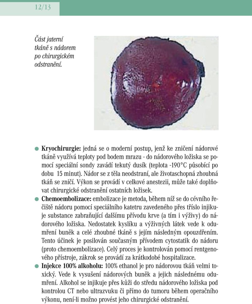 po dobu 15 minut). Nádor se z těla neodstraní, ale životaschopná zhoubná tkáň se zničí. Výkon se provádí v celkové anestezii, může také doplňovat chirurgické odstranění ostatních ložisek.
