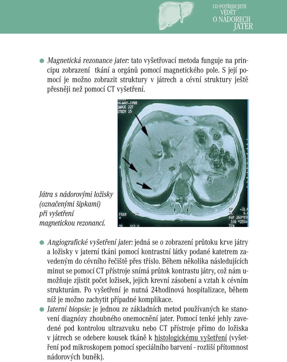 Angiografické vyšetření jater: jedná se o zobrazení průtoku krve játry a ložisky v jaterní tkáni pomocí kontrastní látky podané katetrem zavedeným do cévního řečiště přes tříslo.