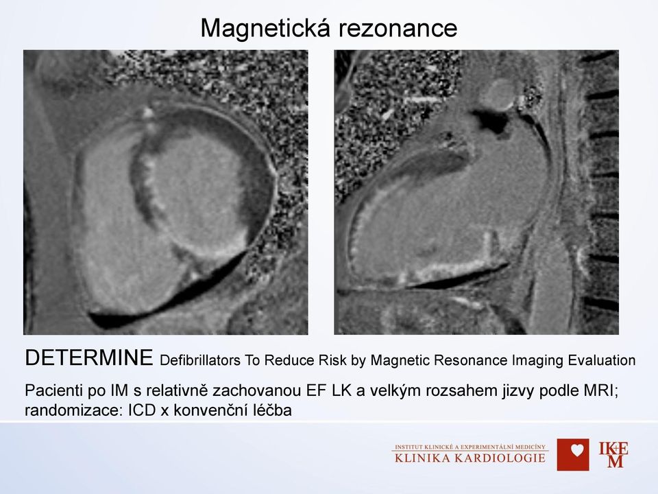 Pacienti po IM s relativně zachovanou EF LK a velkým
