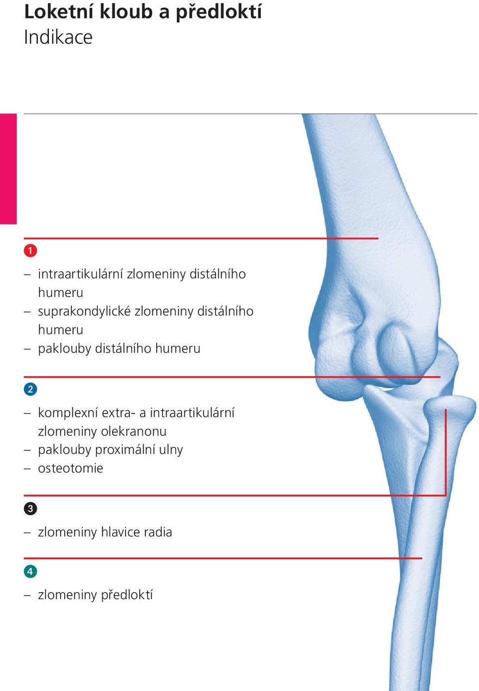distálního humeru komplexní extra- a intraartikulární zlomeniny