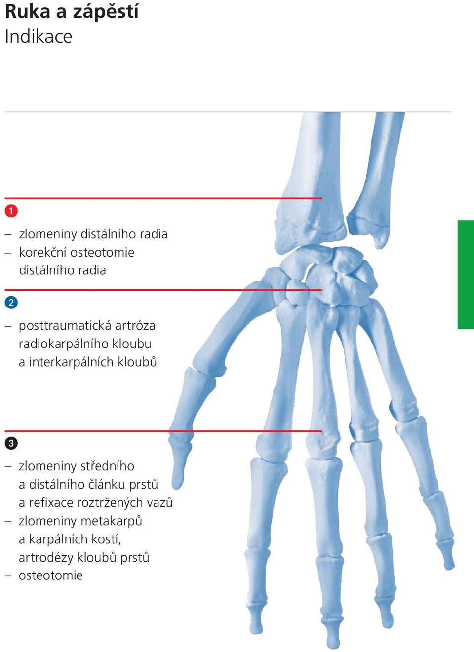 interkarpálních kloubů zlomeniny středního a distálního článku prstů a