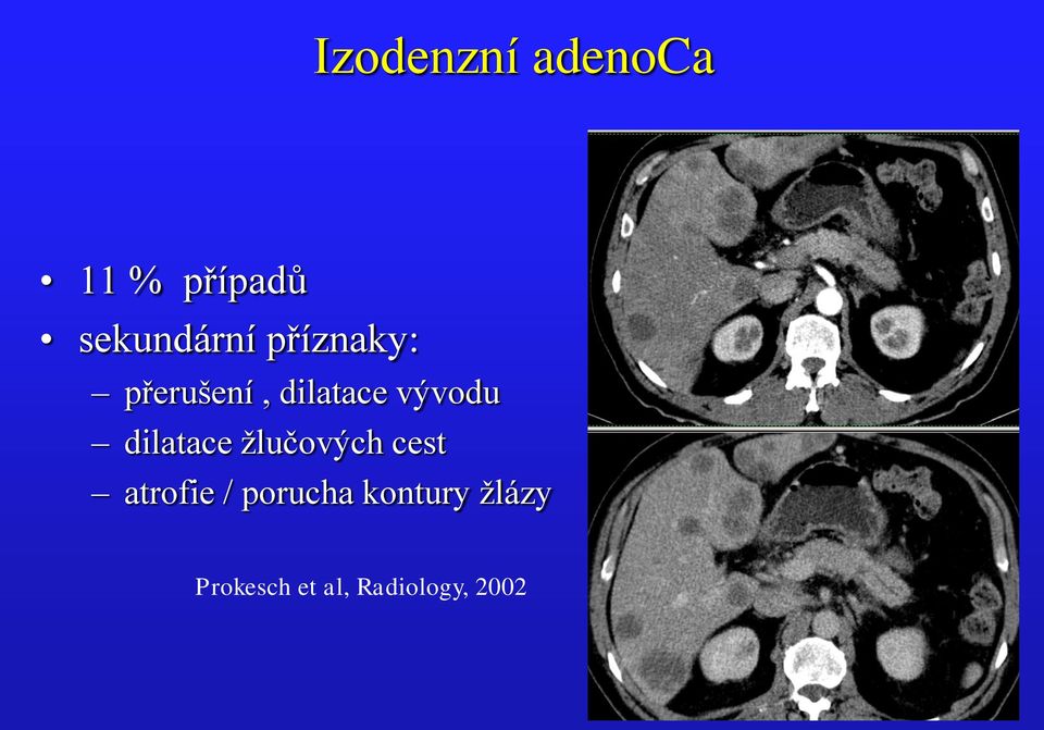 dilatace žlučových cest atrofie / porucha