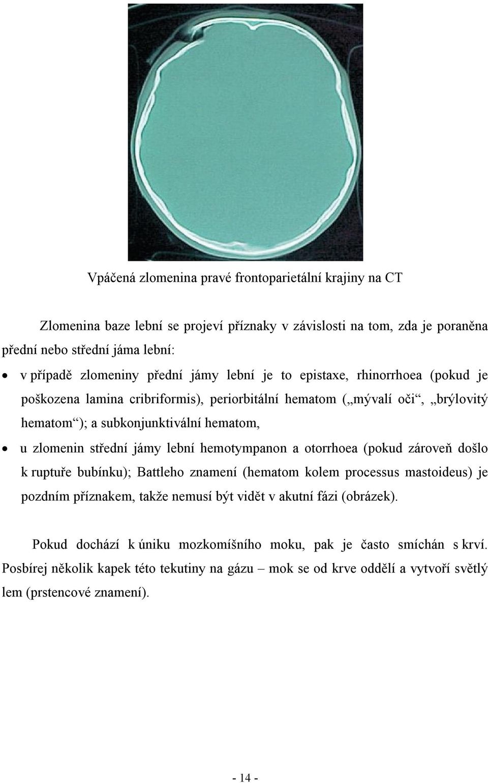 lební hemotympanon a otorrhoea (pokud zároveň došlo k ruptuře bubínku); Battleho znamení (hematom kolem processus mastoideus) je pozdním příznakem, takže nemusí být vidět v akutní fázi