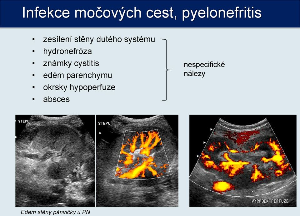 cystitis edém parenchymu okrsky hypoperfuze