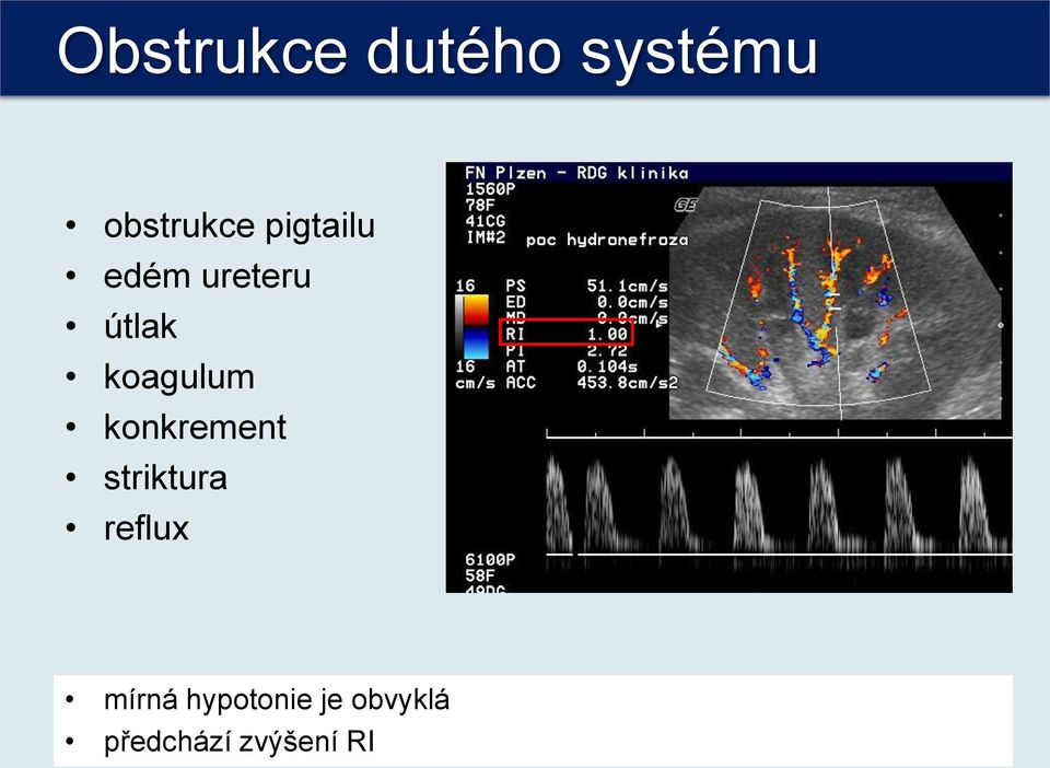 konkrement striktura reflux mírná