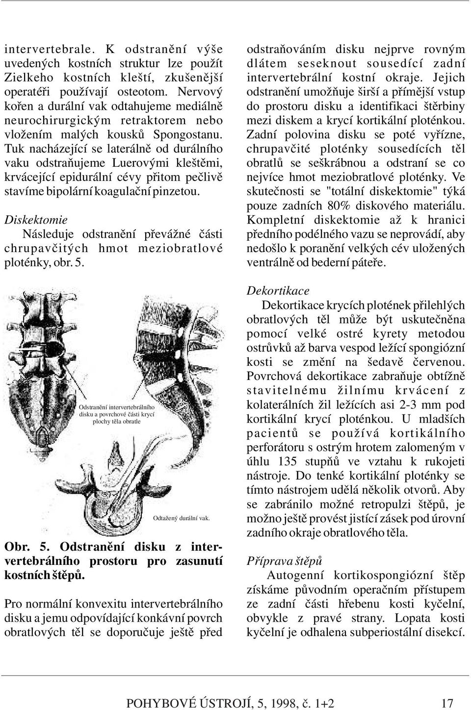 Tuk nacházející se laterálně od durálního vaku odstraňujeme Luerovými kleštěmi, krvácející epidurální cévy přitom pečlivě stavíme bipolární koagulační pinzetou.