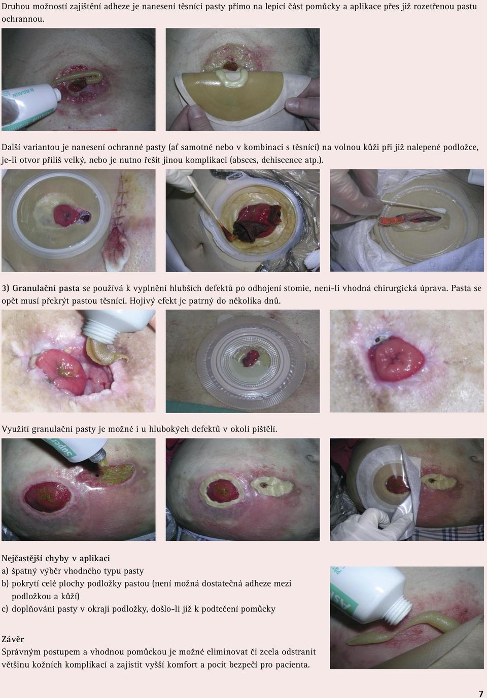 dehiscence atp.). 3) Granulační pasta se používá k vyplnění hlubších defektů po odhojení stomie, není-li vhodná chirurgická úprava. Pasta se opět musí překrýt pastou těsnící.