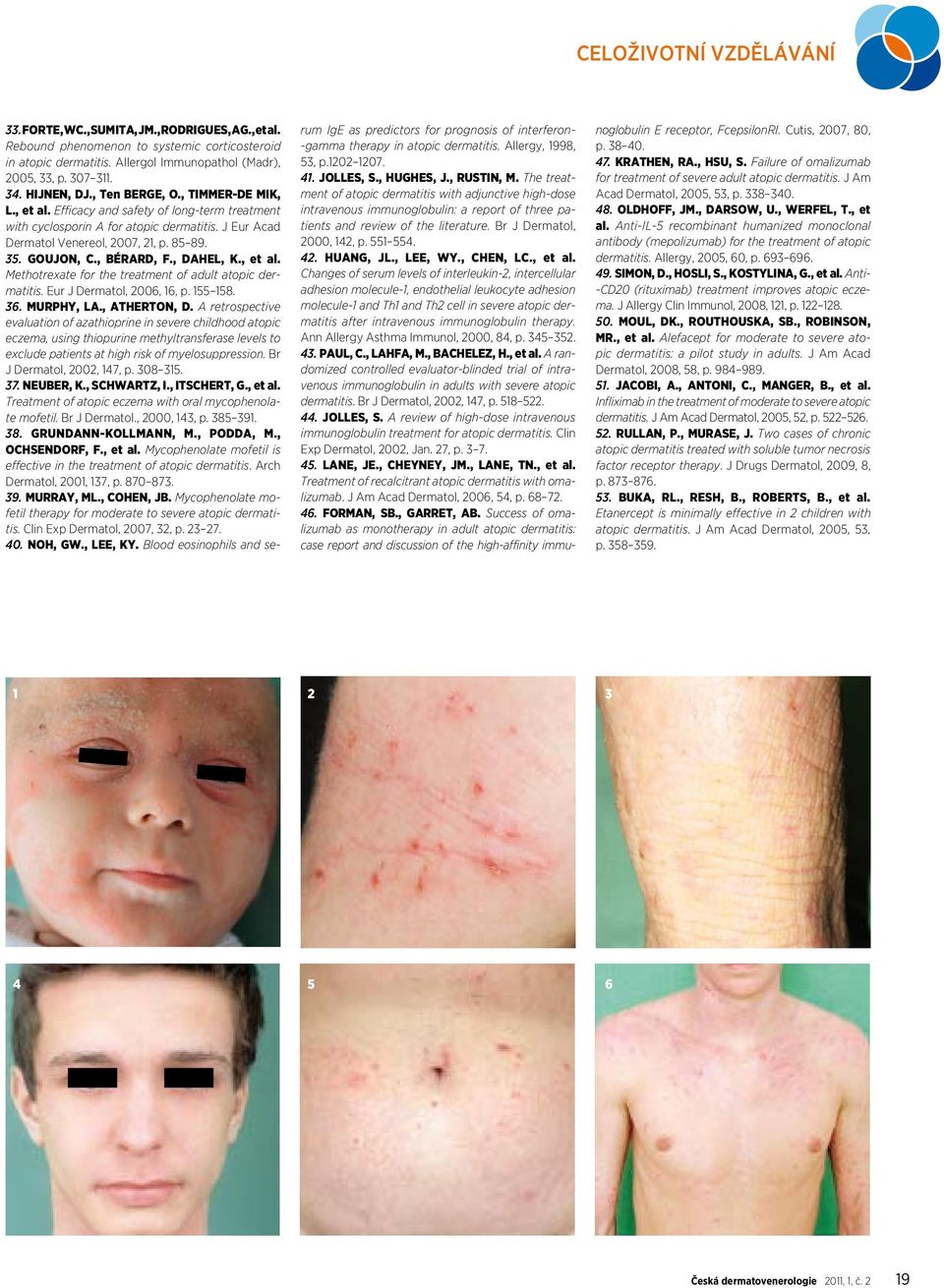 GOUJON, C., BÉRARD, F., DAHEL, K., et al. Methotrexate for the treatment of adult atopic dermatitis. Eur J Dermatol, 2006, 16, p. 155 158. 36. MURPHY, LA., ATHERTON, D.