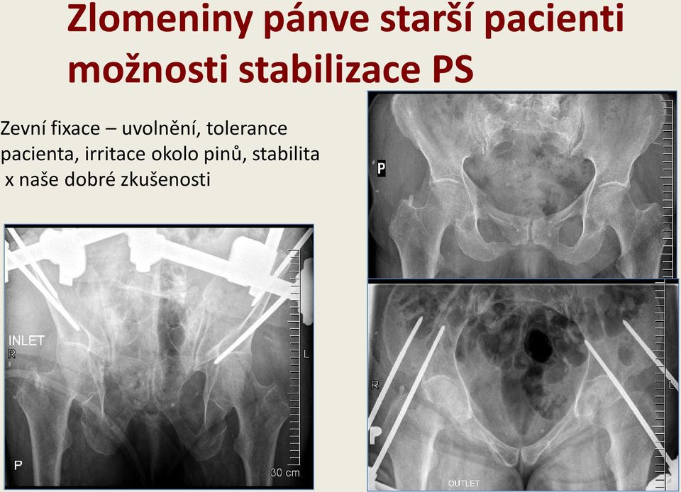 pacienta, irritace okolo pinů,