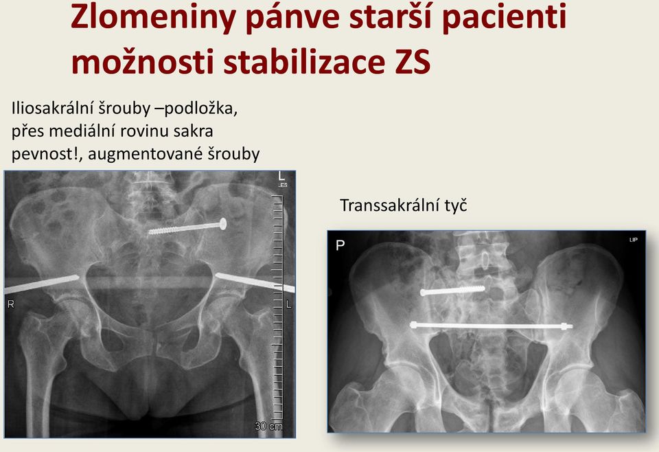 přes mediální rovinu sakra