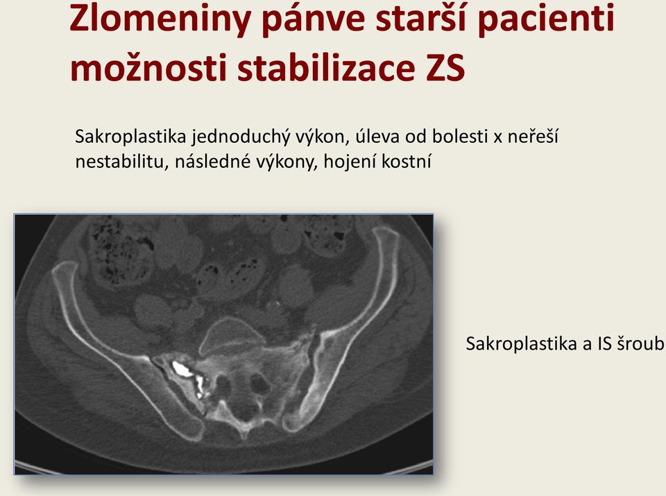 neřeší nestabilitu, následné výkony,