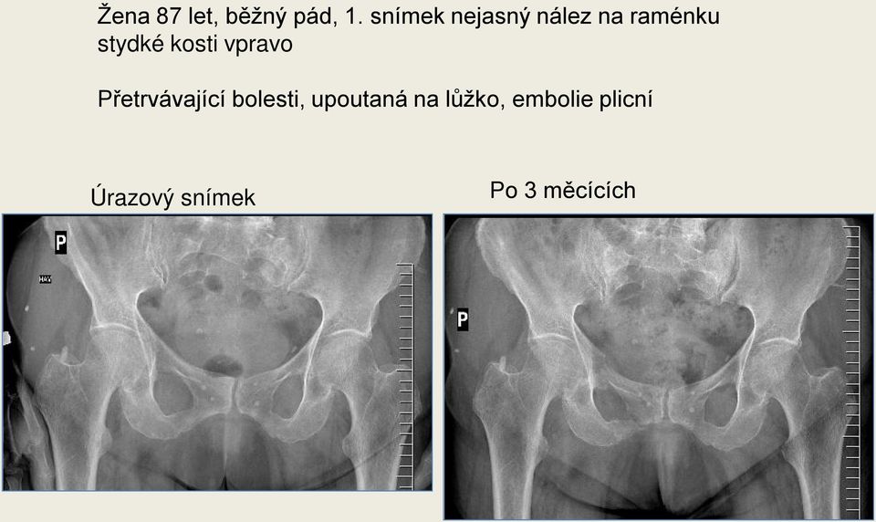 kosti vpravo Přetrvávající bolesti,