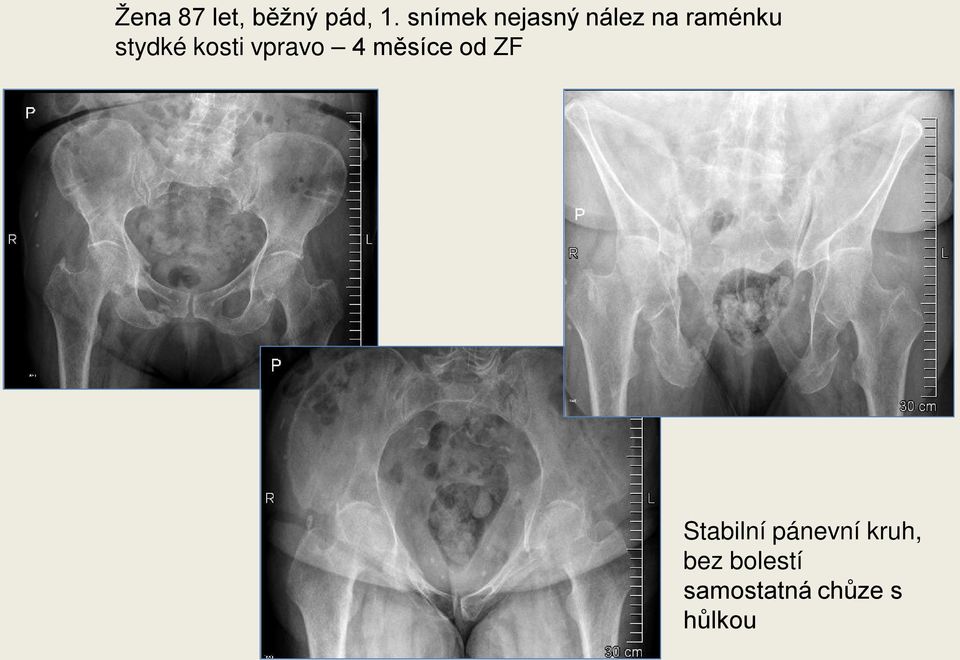 kosti vpravo 4 měsíce od ZF Stabilní