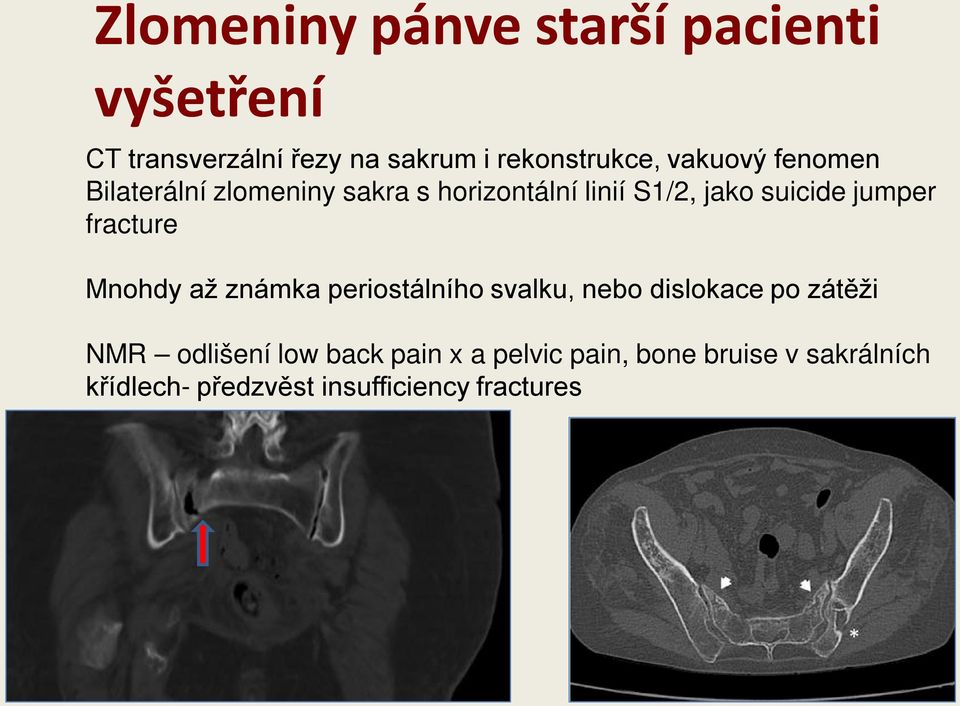 Mnohdy až známka periostálního svalku, nebo dislokace po zátěži NMR odlišení low