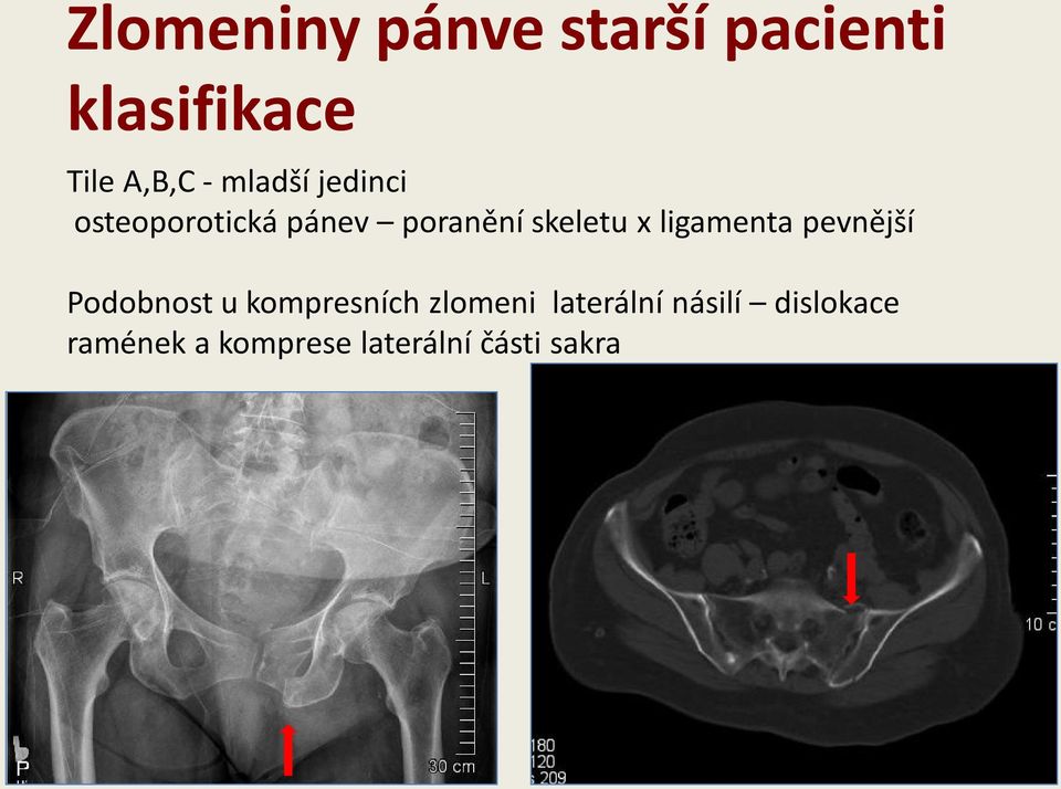 pevnější Podobnost u kompresních zlomeni