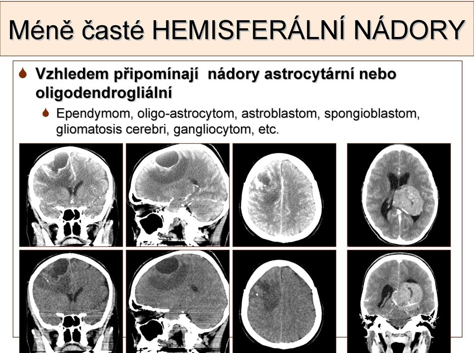 oligodendrogliální Ependymom, oligo-astrocytom,