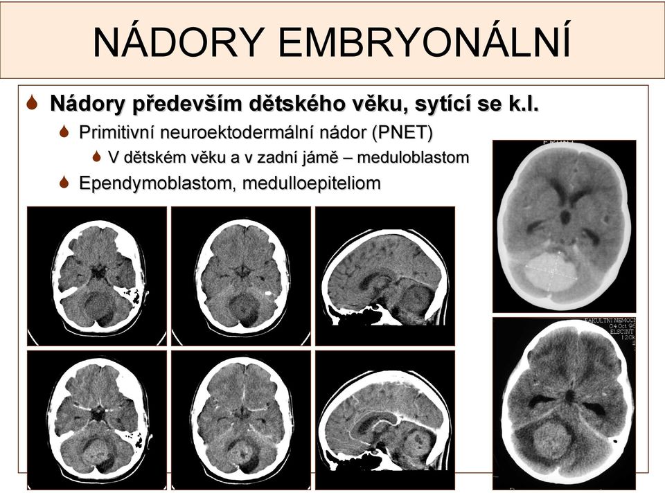Primitivní neuroektodermální nádor (PNET) V