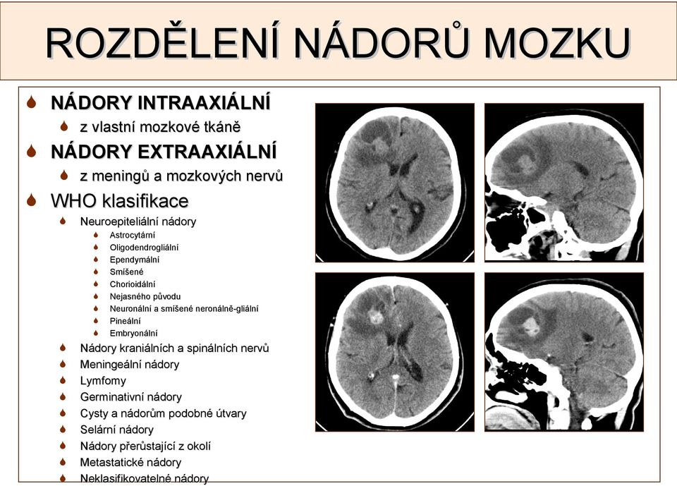 Neuronální a smíšené neronálně-gliální Pineální Embryonální Nádory kraniálních a spinálních nervů Meningeální nádory Lymfomy