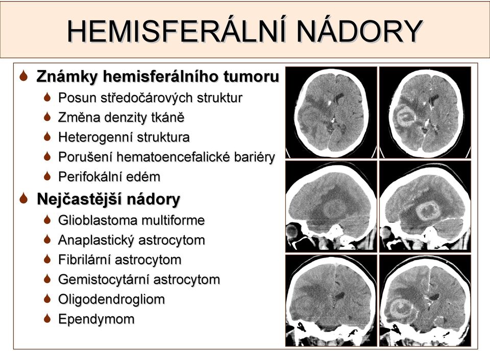 Perifokální edém Nejčastější nádory Glioblastoma multiforme Anaplastický