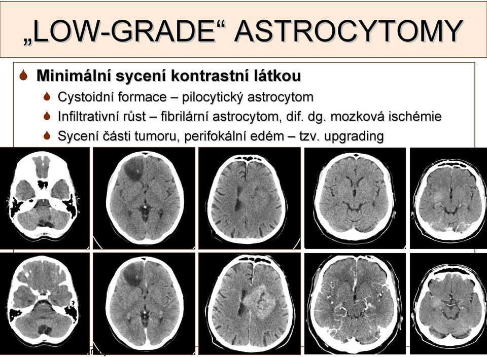 fibrilární astrocytom, dif. dg.