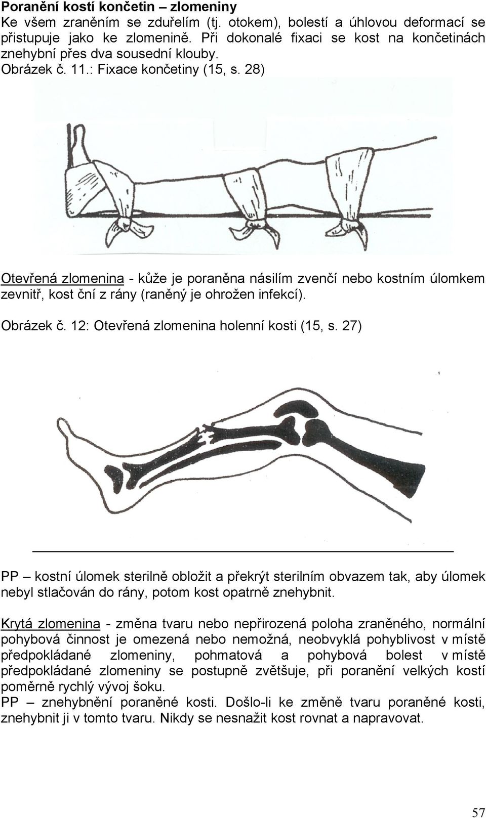 28) Otevřená zlomenina - kůže je poraněna násilím zvenčí nebo kostním úlomkem zevnitř, kost ční z rány (raněný je ohrožen infekcí). Obrázek č. 12: Otevřená zlomenina holenní kosti (15, s.