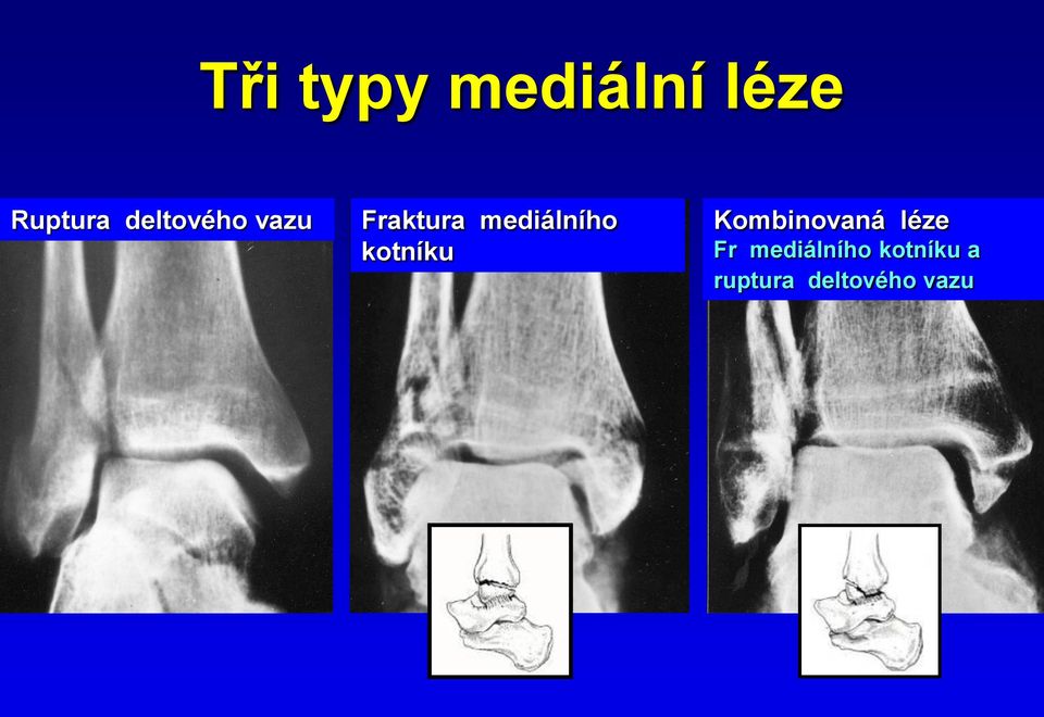 kotníku Kombinovaná léze Fr