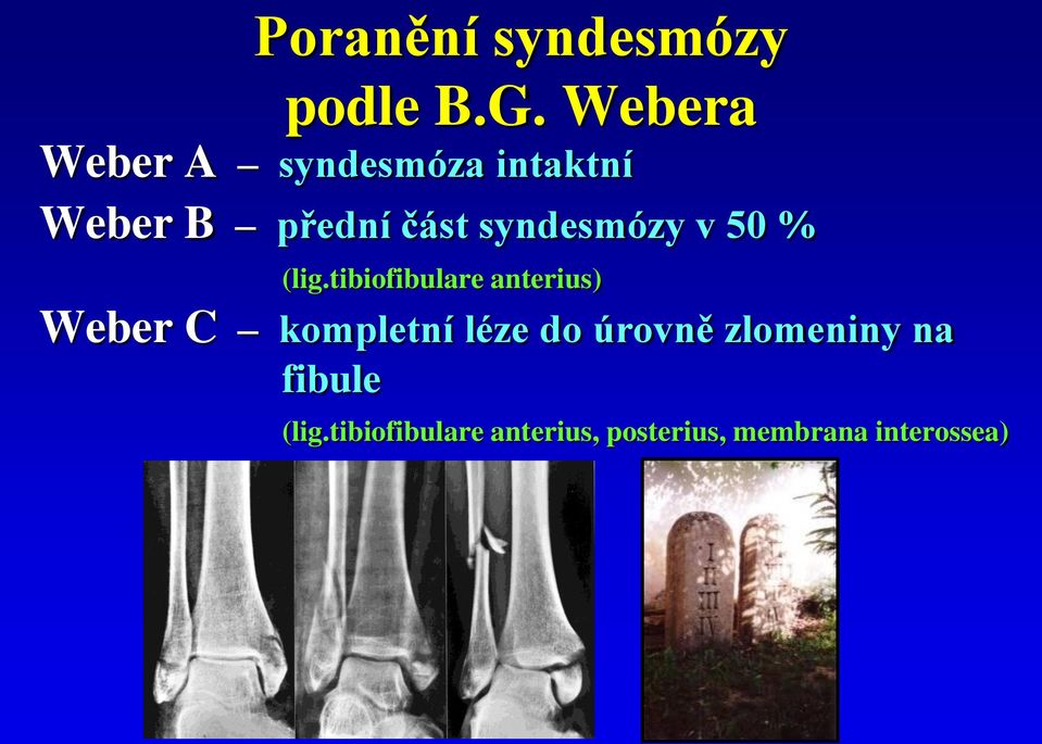 syndesmózy v 50 % (lig.