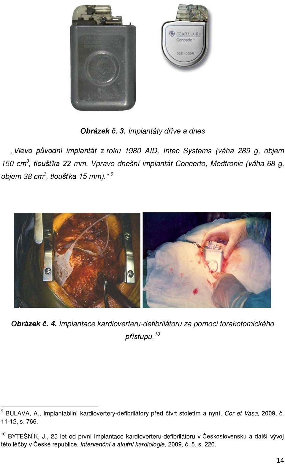 Implantace kardioverteru-defibrilátoru za pomoci torakotomického přístupu. 10 9 BULAVA, A.