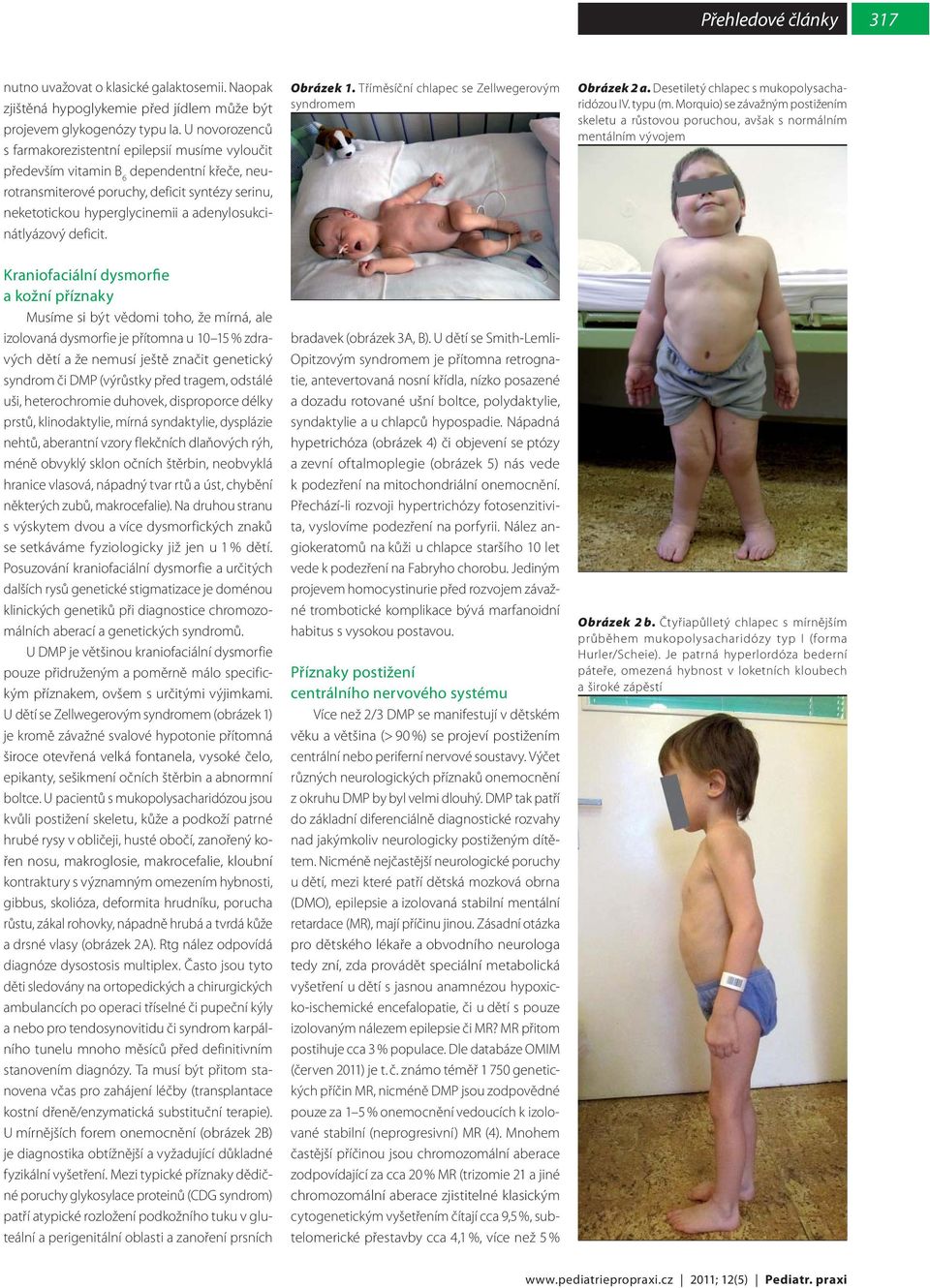 adenylosukcinátlyázový deficit. Obrázek 1. Tříměsíční chlapec se Zellwegerovým syndromem Obrázek 2 a. Desetiletý chlapec s mukopolysacharidózou IV. typu (m.